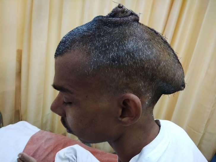 Paciente indiano sobrevive à extração de tumor cerebral de quase 2 kg
