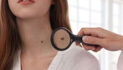 Câncer de pele melanoma:
