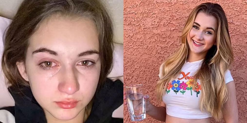 Conheça o drama de Abigail Beck, a jovem que tem alergia à água