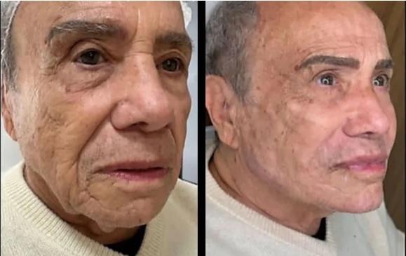 Stênio Garcia e Marilene Saad renovam visual com procedimentos estéticos em São Paulo
