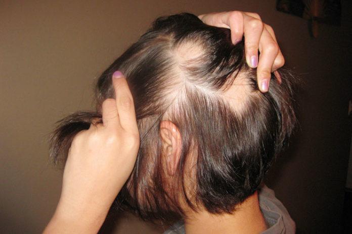 Maiara, da Dupla Maiara & Maraísa, Revela Luta Contra Alopecia e Seu Tratamento