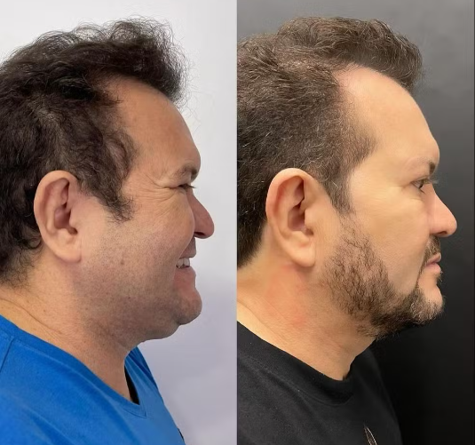 Ximbinha Revela Resultado de Cirurgia Facial