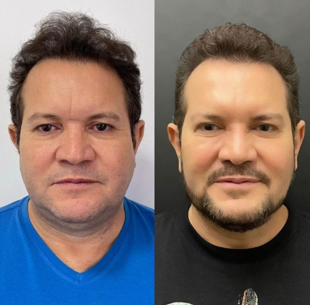 Ximbinha Revela Resultado de Cirurgia Facial